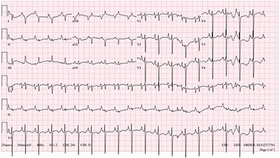 Case Report: Sustained ventricular arrhythmia in a child supported by a Berlin heart EXCOR ventricular assist device